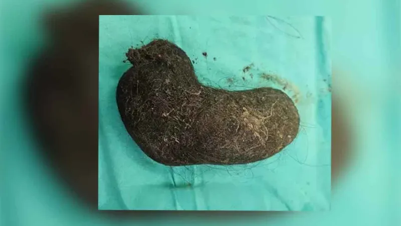 9 yaşındaki çocuğun midesinden çıkan şoke etti! Uzmanlar uyardı: Son yıllarda artıyor